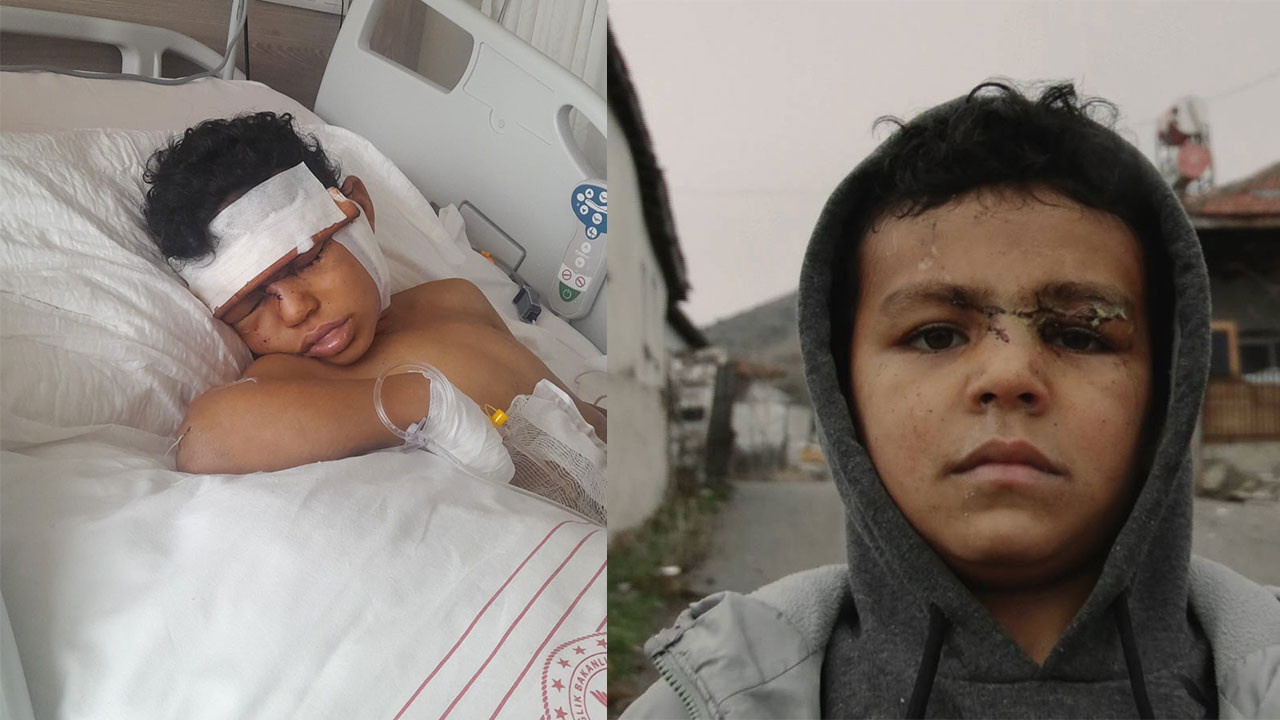 Yenimahalle'de sokak köpeği 5 yaşındaki çocuğun yüzünü parçaladı