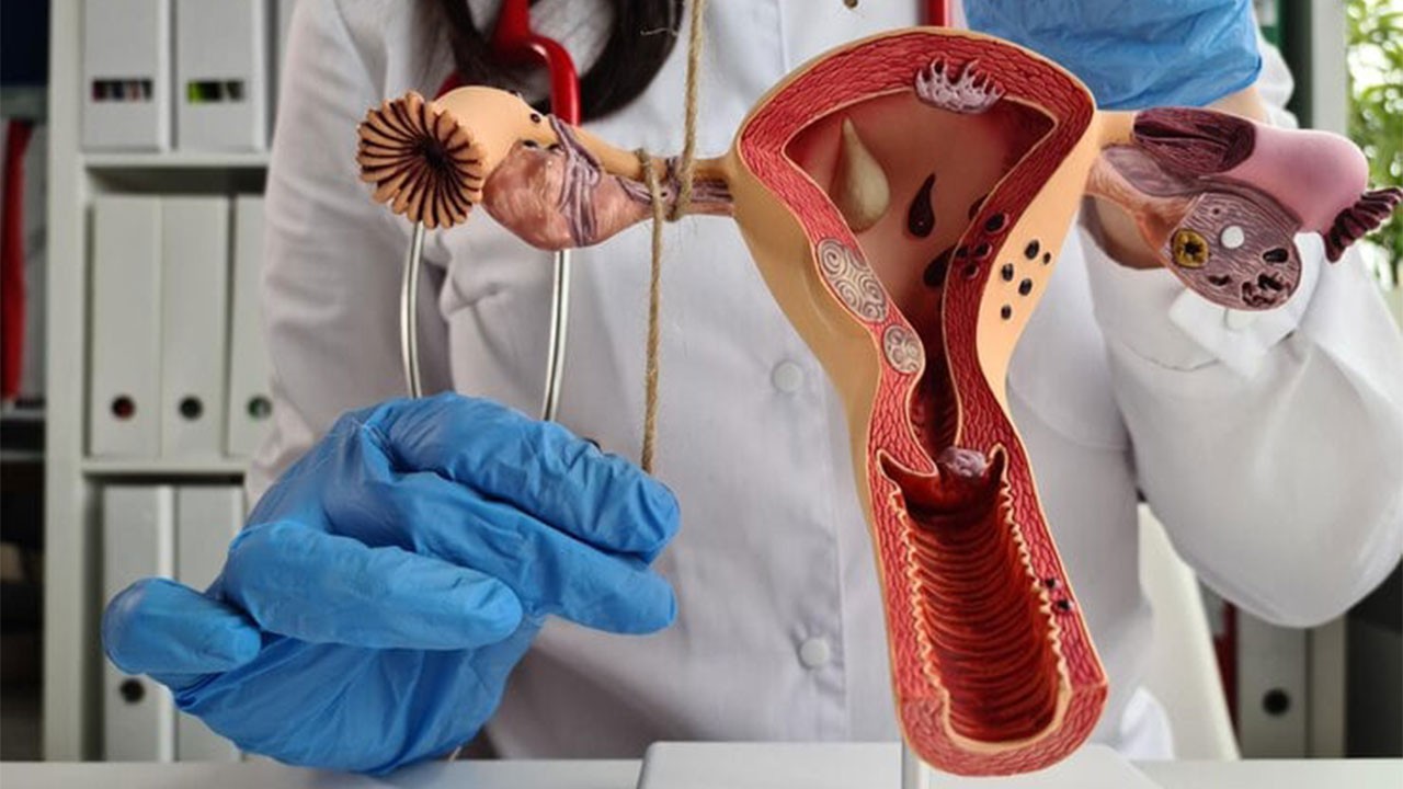 Adenom, adenomyozis nedir?
