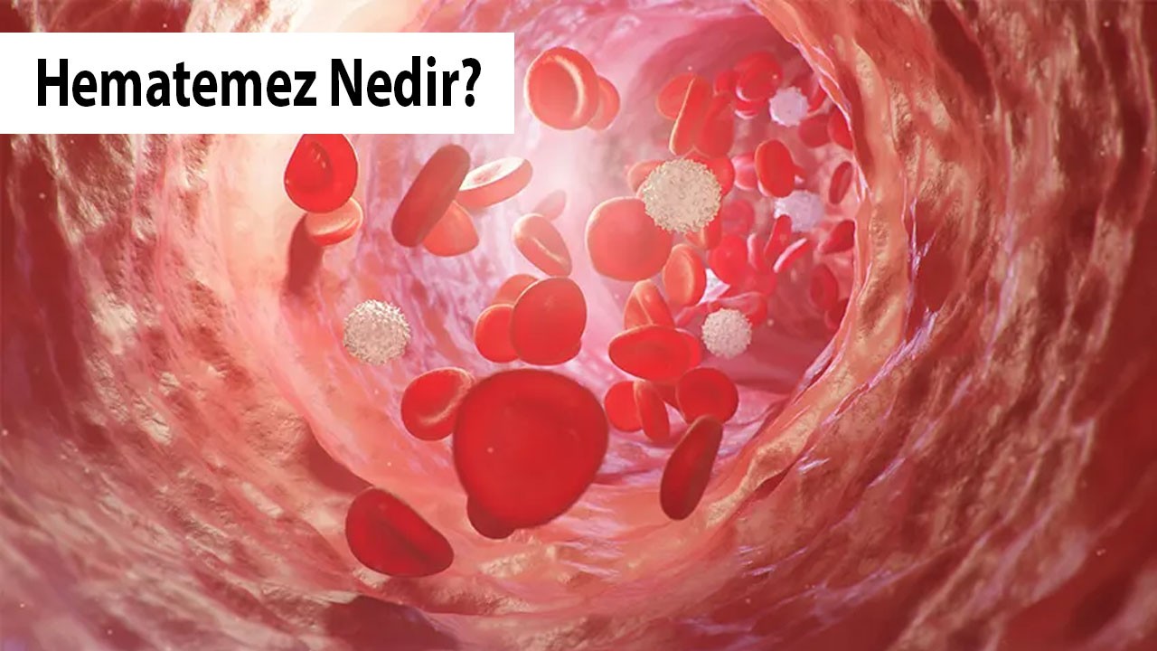 Hematemez Nedir?