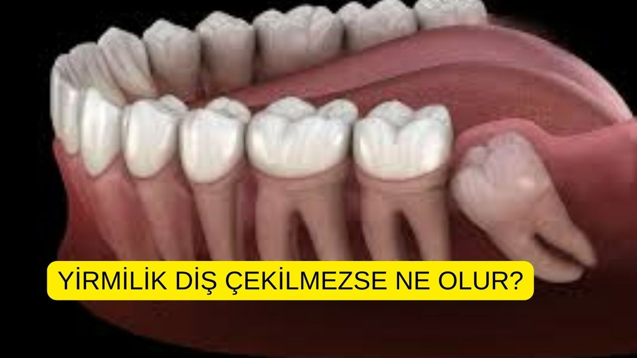Yirmilik diş çekilmezse ne olur?