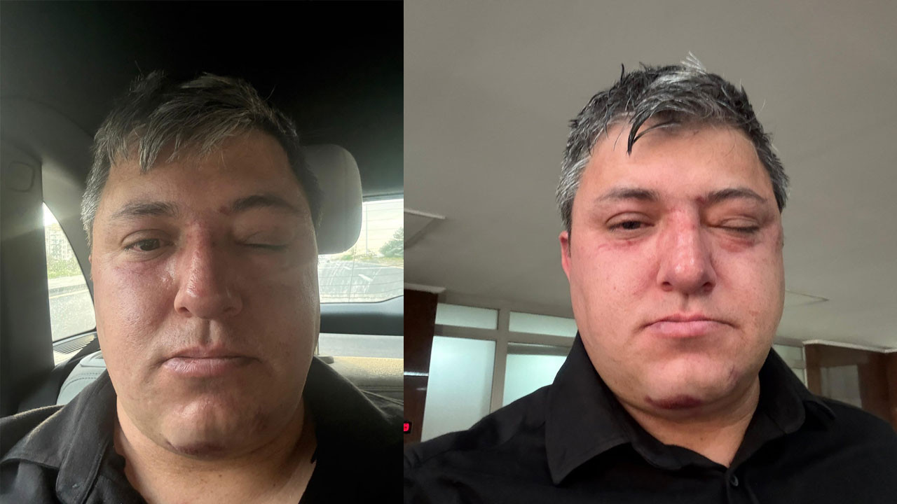 Altındağ Belediyesinde gerginlik bitmiyor! Eski müdür Erdoğan’dan darp iddiası