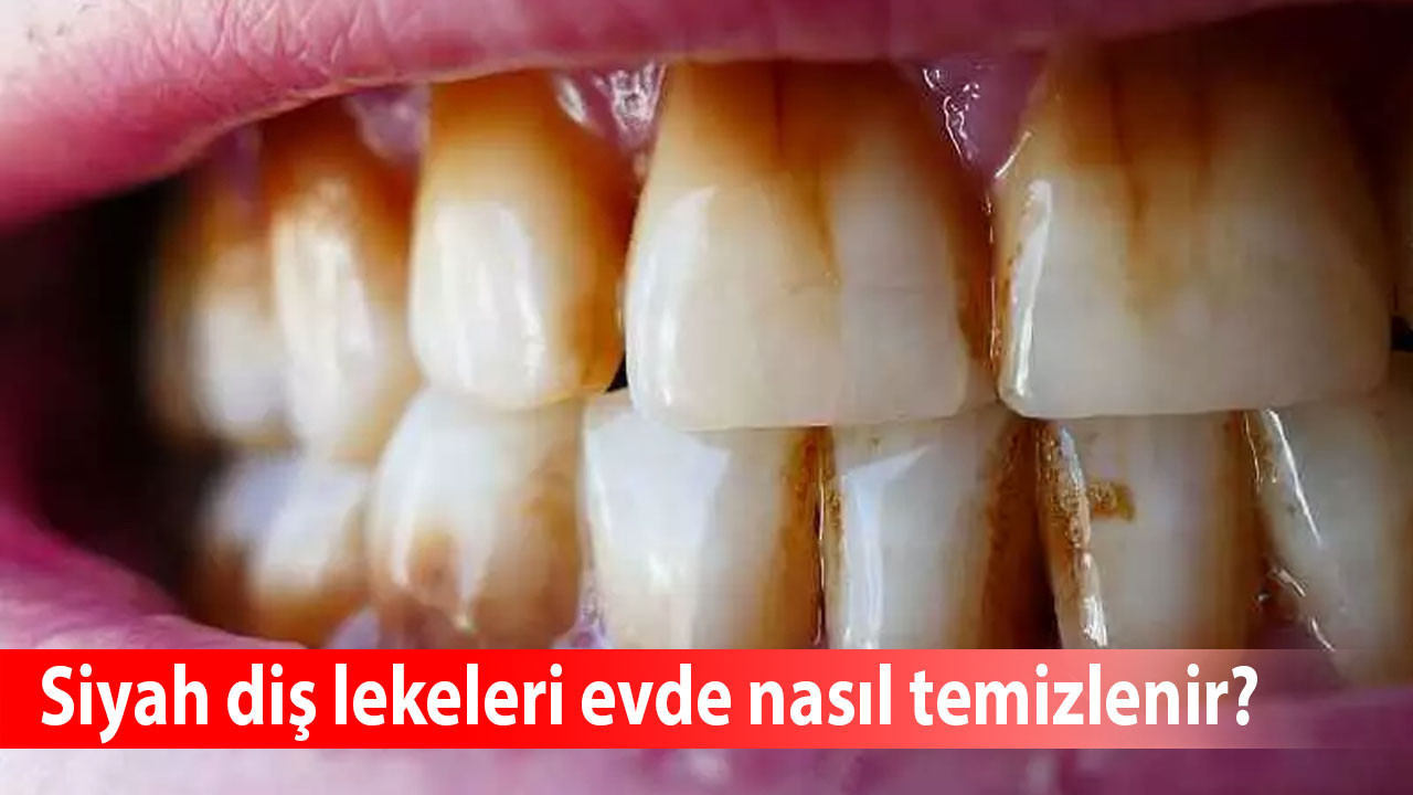 Siyah diş lekeleri evde nasıl temizlenir? Sigaradan oluşan diş lekeleri nasıl temizlenir?