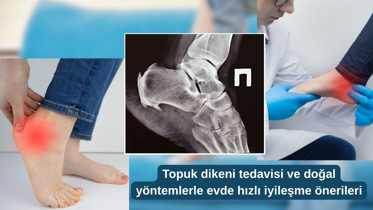 Topuk dikeni tedavisi ve doğal yöntemlerle evde hızlı iyileşme önerileri