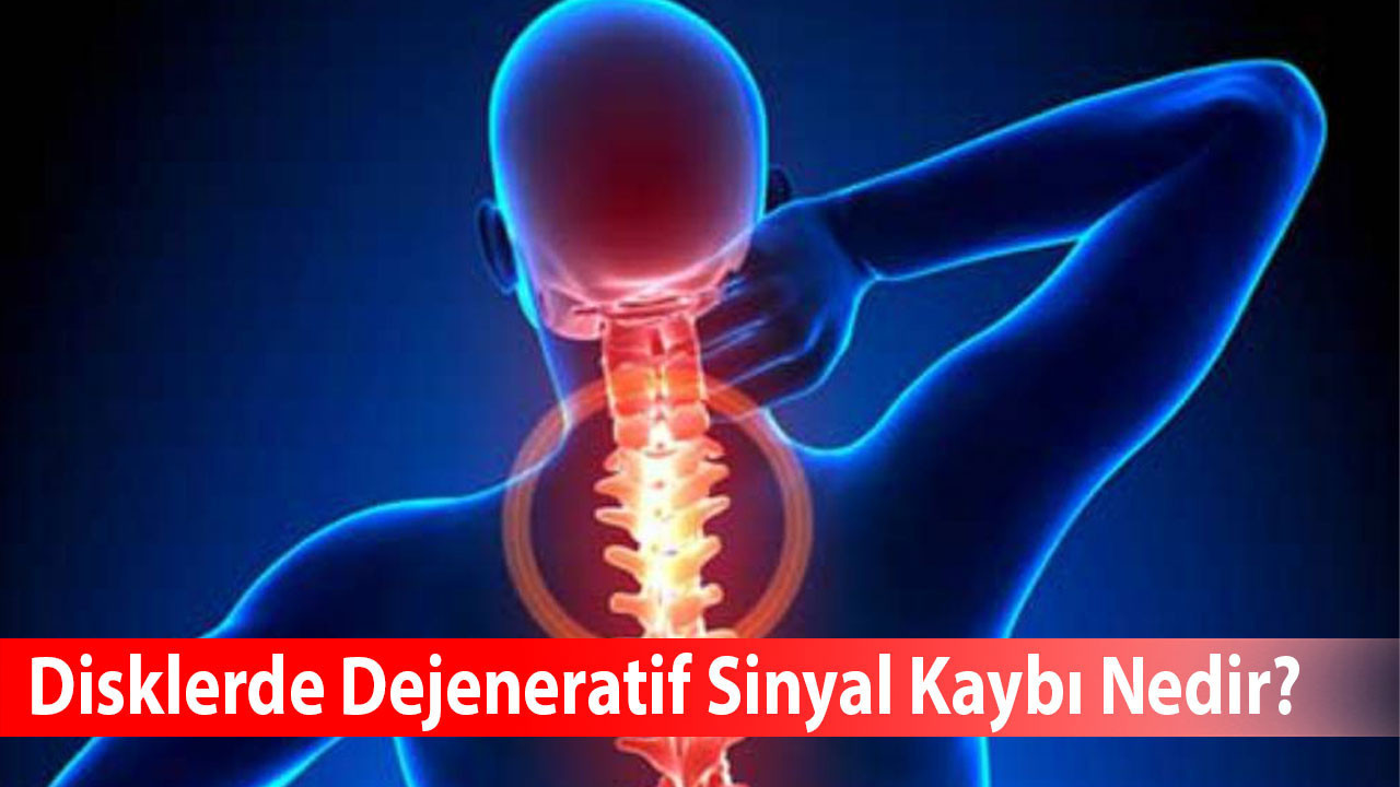 Disklerde Dejeneratif Sinyal Kaybı Nedir?