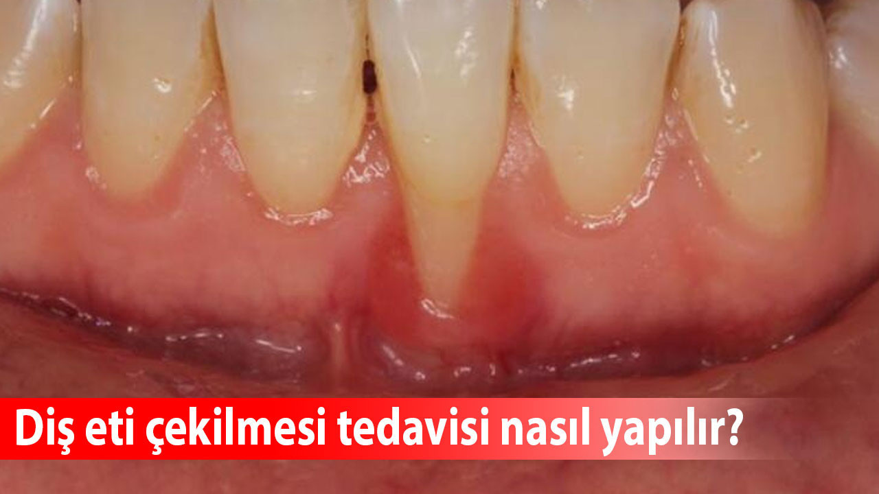 Diş eti çekilmesi tedavisi nasıl yapılır? Diş eti çekilmesi nasıl durdurulur? Çekilen diş eti tekrar düzelir mi?