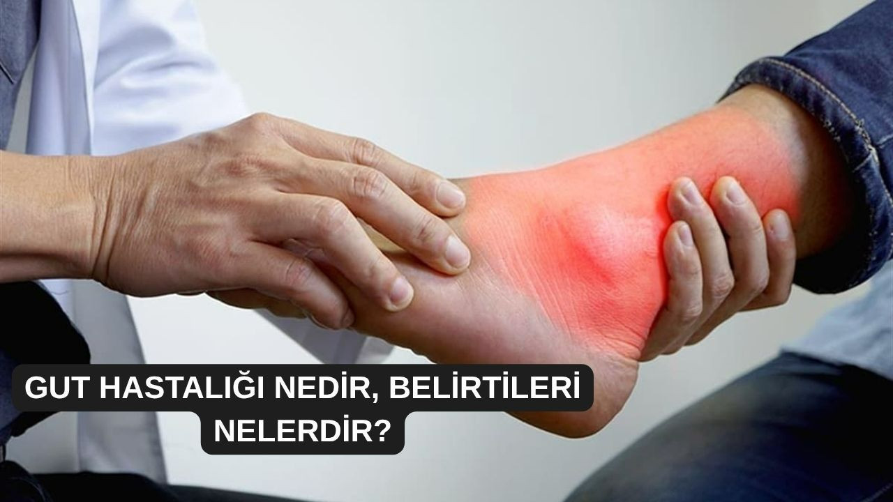Gut hastalığı nedir, belirtileri nelerdir?