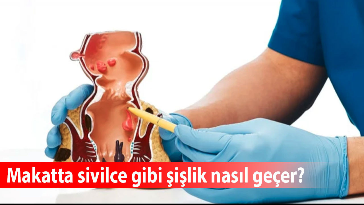 Makatta sivilce gibi şişlik nasıl geçer? Makatta sivilce neden olur? Makatta şişkinlik kendiliğinden geçer mi?