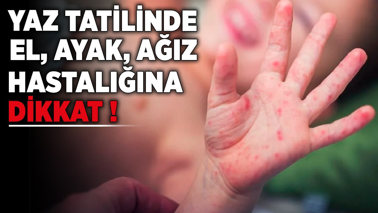 Uzmanlar uyarıyor: Yaz tatilinde el, ayak, ağız hastalığına dikkat!