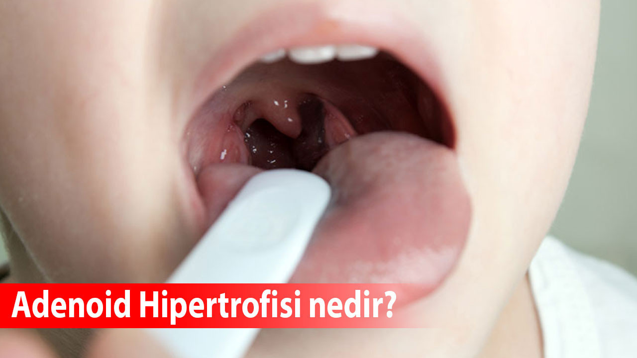 Adenoid Hipertrofisi nedir?
