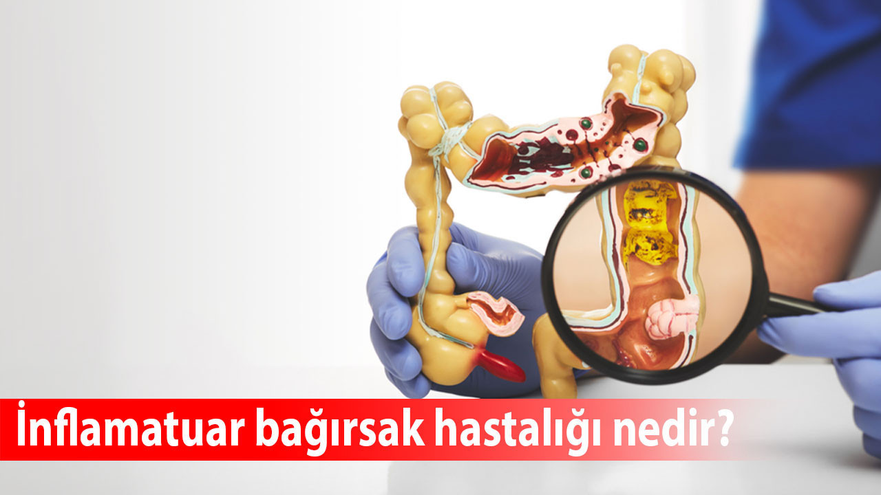 İnflamatuar bağırsak hastalığı nedir, belirtileri nelerdir? Bağırsak inflamasyonuna ne iyi gelir?