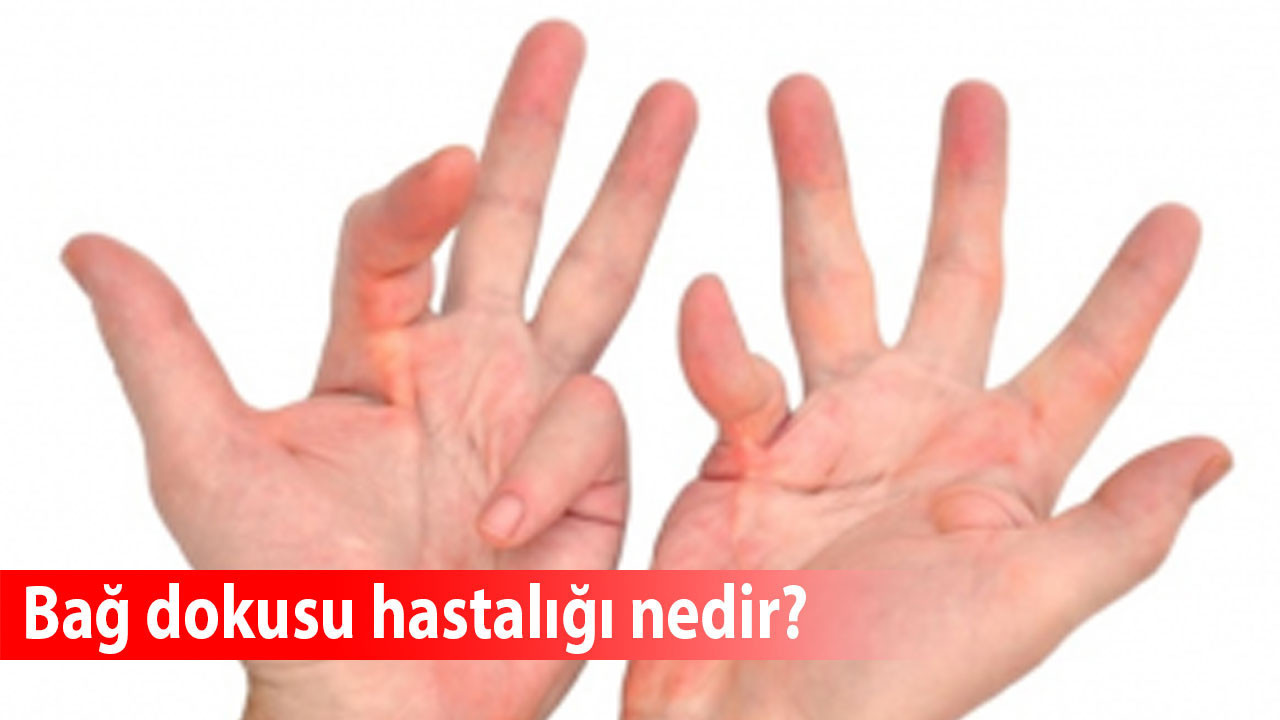 Bağ dokusu hastalığı nedir?