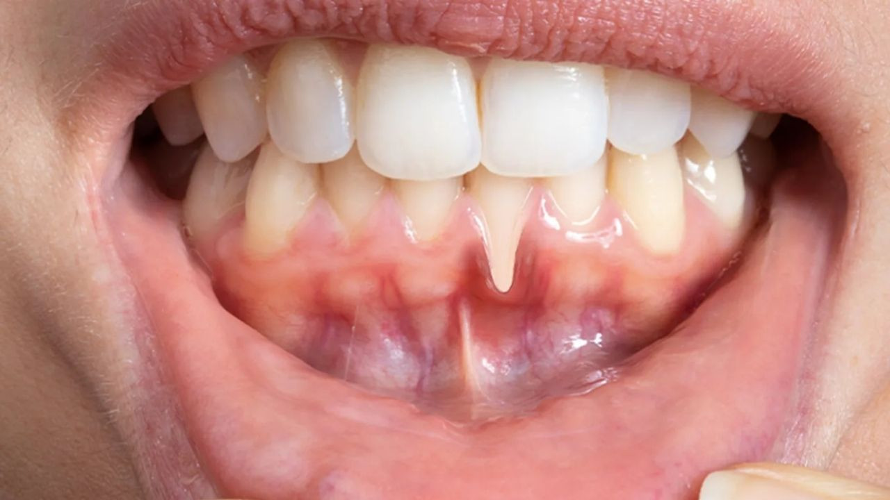 Damak morarması neden olur?