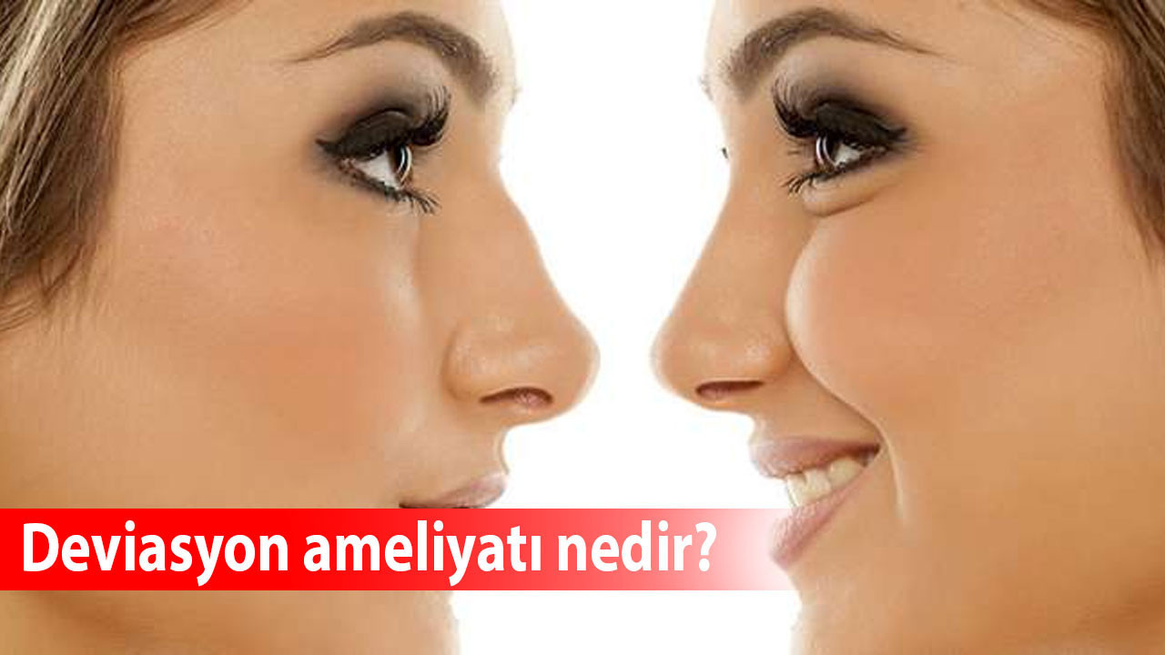 Deviasyon ameliyatı nedir?
