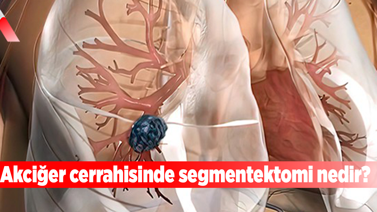 Akciğer cerrahisinde segmentektomi nedir?