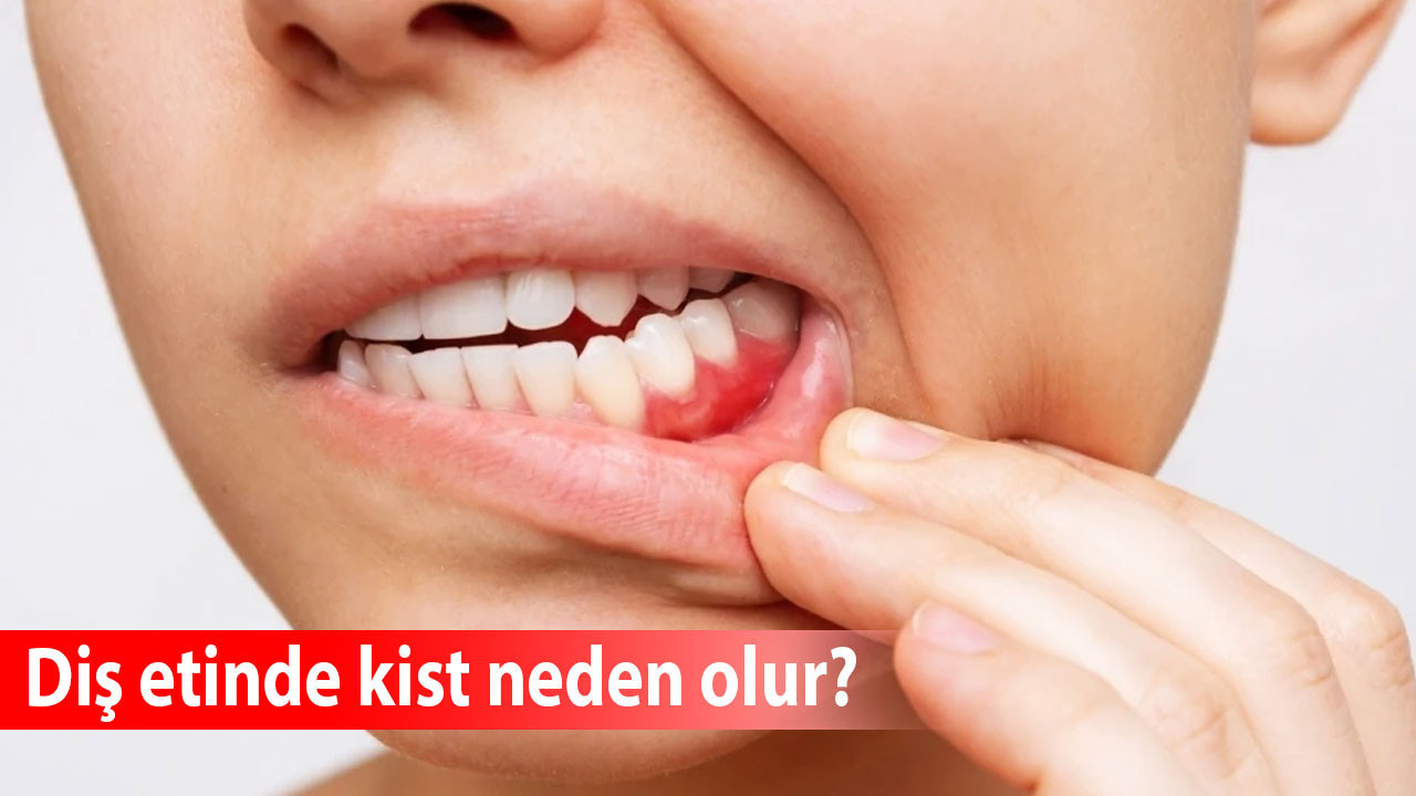 Diş etinde kist neden olur?