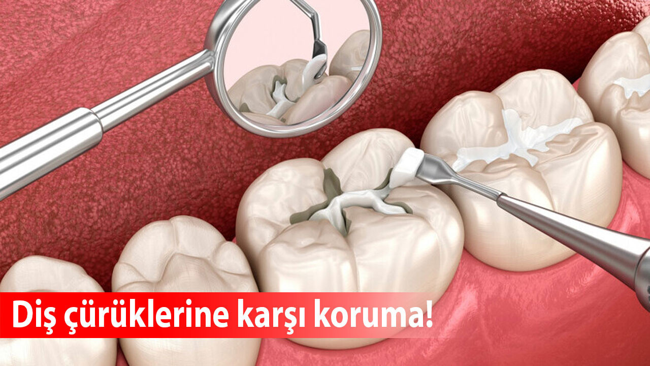 Diş çürüklerine karşı koruma: Fissür örtücü uygulaması nasıl yapılır?