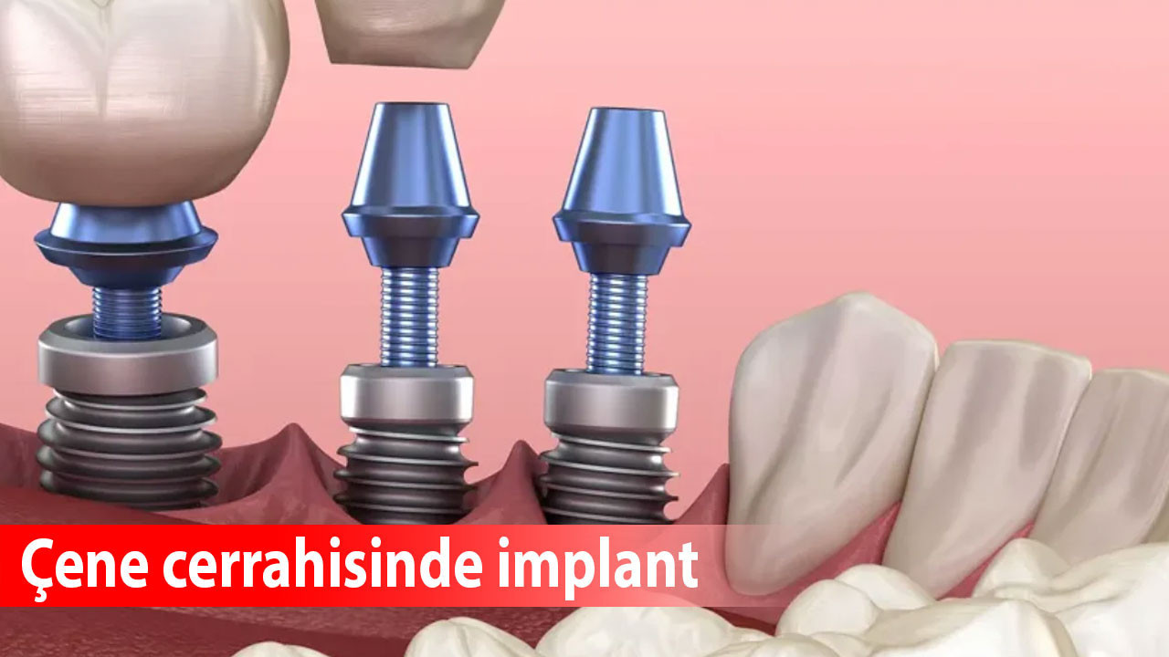 Çene cerrahisinde implant: İşlem süreci ve uzun vadeli başarı