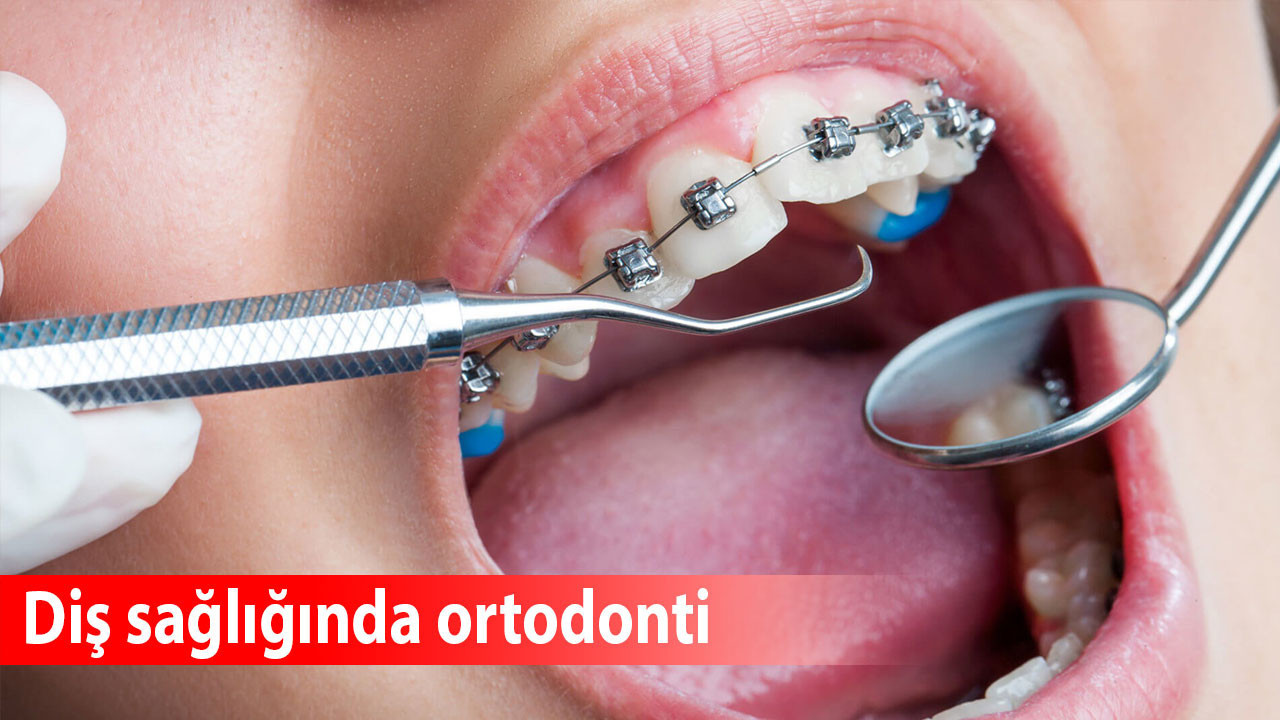 Diş sağlığında ortodonti: Tedavi süreçleri ve modern yaklaşımlar