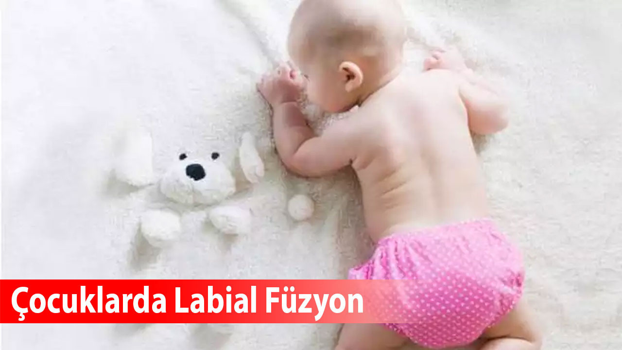 Çocuklarda Labial Füzyon: Belirtiler, nedenleri ve tedavi yaklaşımları