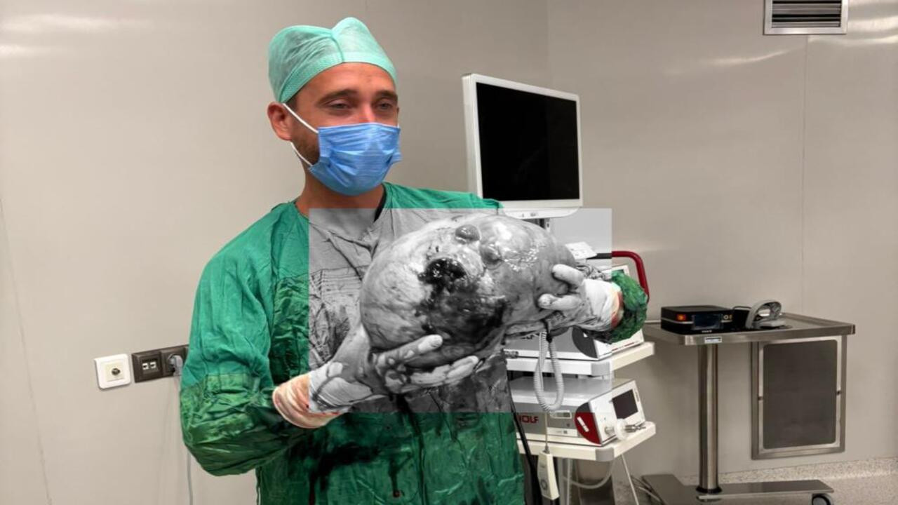 Yozgat’ta bir hastadan çıkarılan kitlenin büyüklüğü görenleri şaşkına çeviriyor