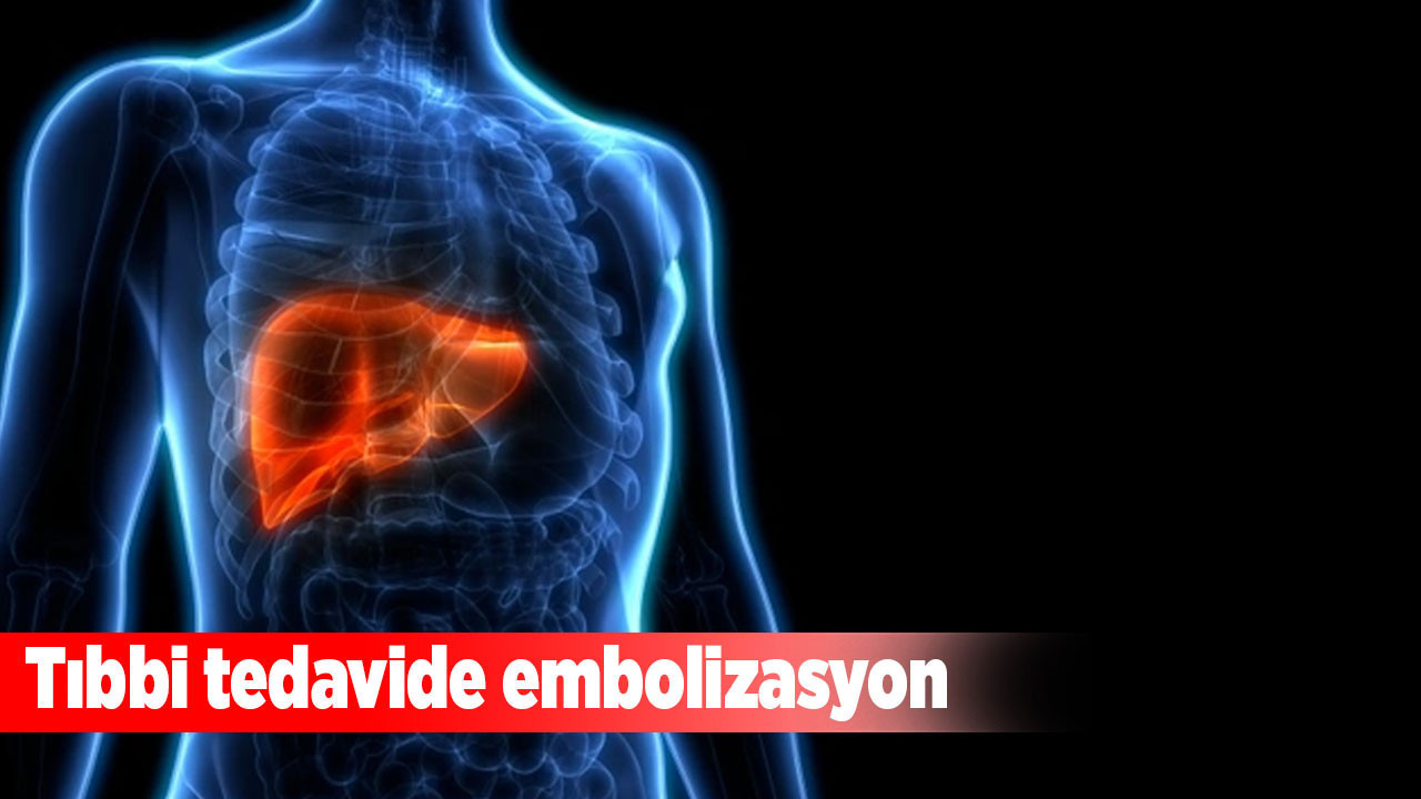 Tıbbi tedavide embolizasyon: İşlem süreci ve uygulama alanları