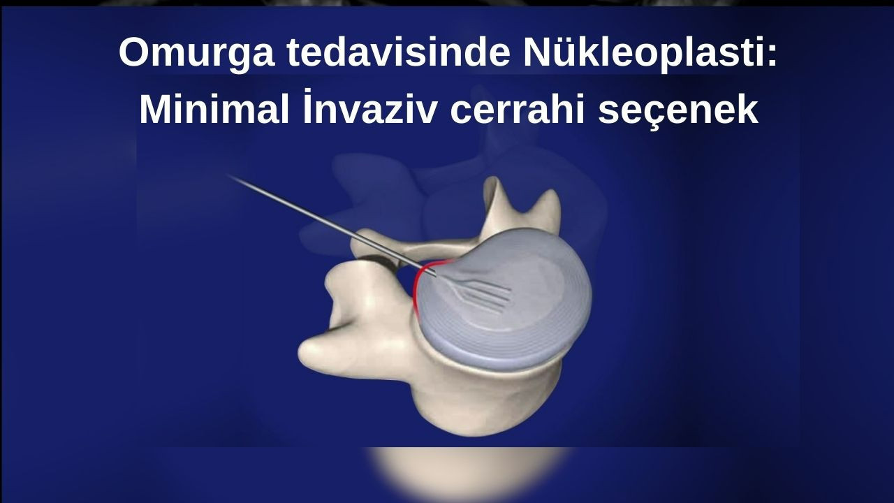Omurga tedavisinde Nükleoplasti: Minimal İnvaziv cerrahi seçenek