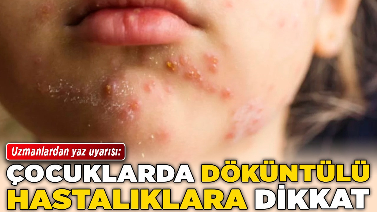 Uzmanlardan yaz uyarısı: Çocuklarda döküntülü hastalıklara dikkat!