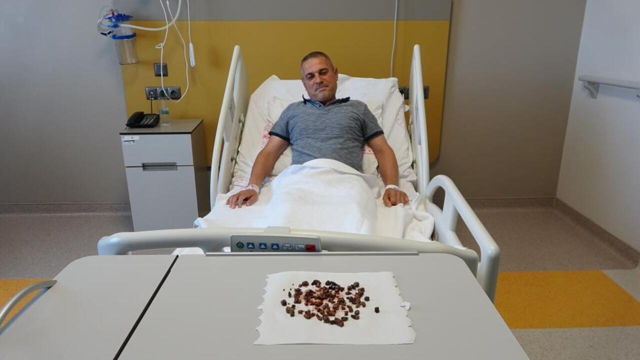 Yozgat’ta bir vatandaşın böbreğinden çıkan taş sayısı duyanları şaşkına çevirdi