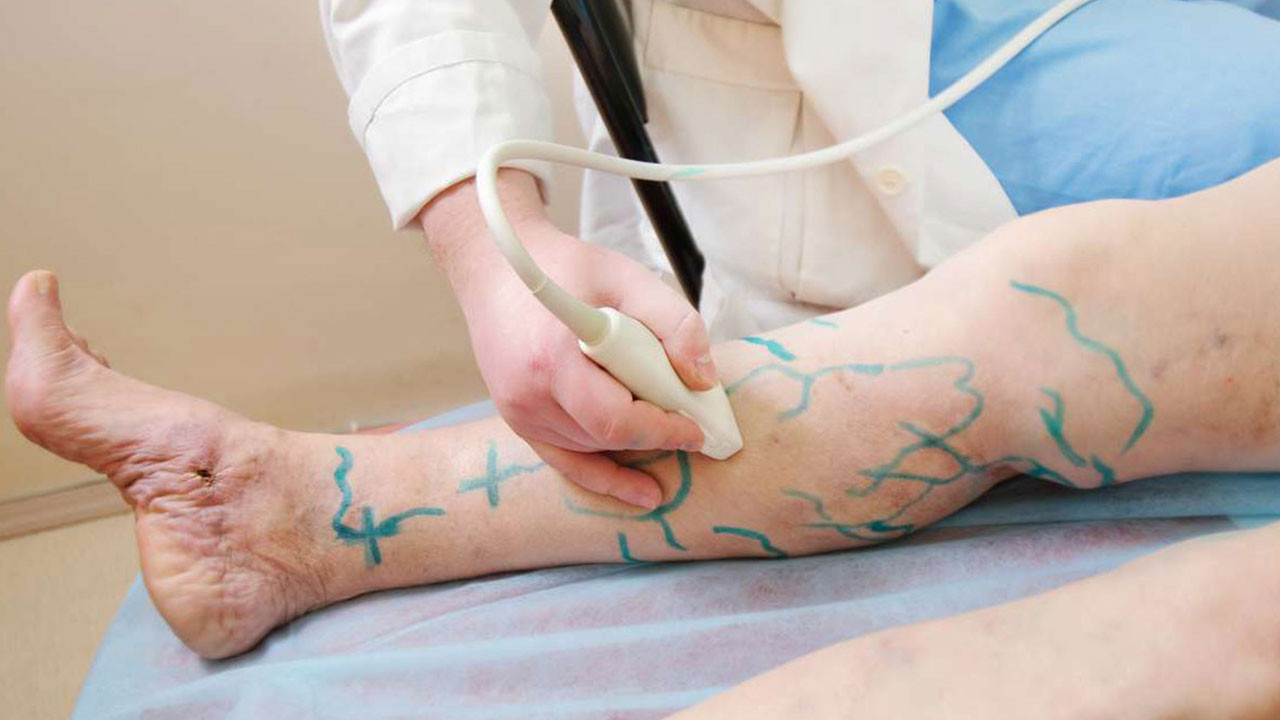 Uzmanından varis uyarısı: Belirtileri ciddiye alınmalı