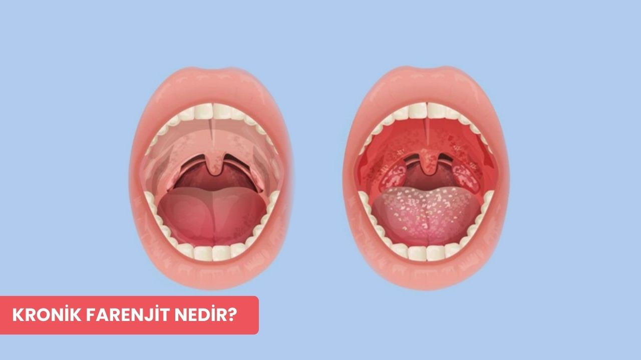 Kronik farenjit nedir? Belirtileri ve tedavi yöntemleri nelerdir?