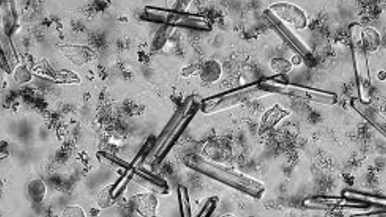 İdrarda kristal yüksekliği neden olur?