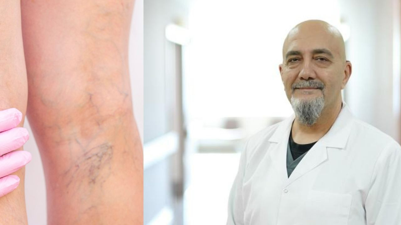 Uzmanı uyardı: Bacaklardaki ağrı ve şişlik varis habercisi olabilir