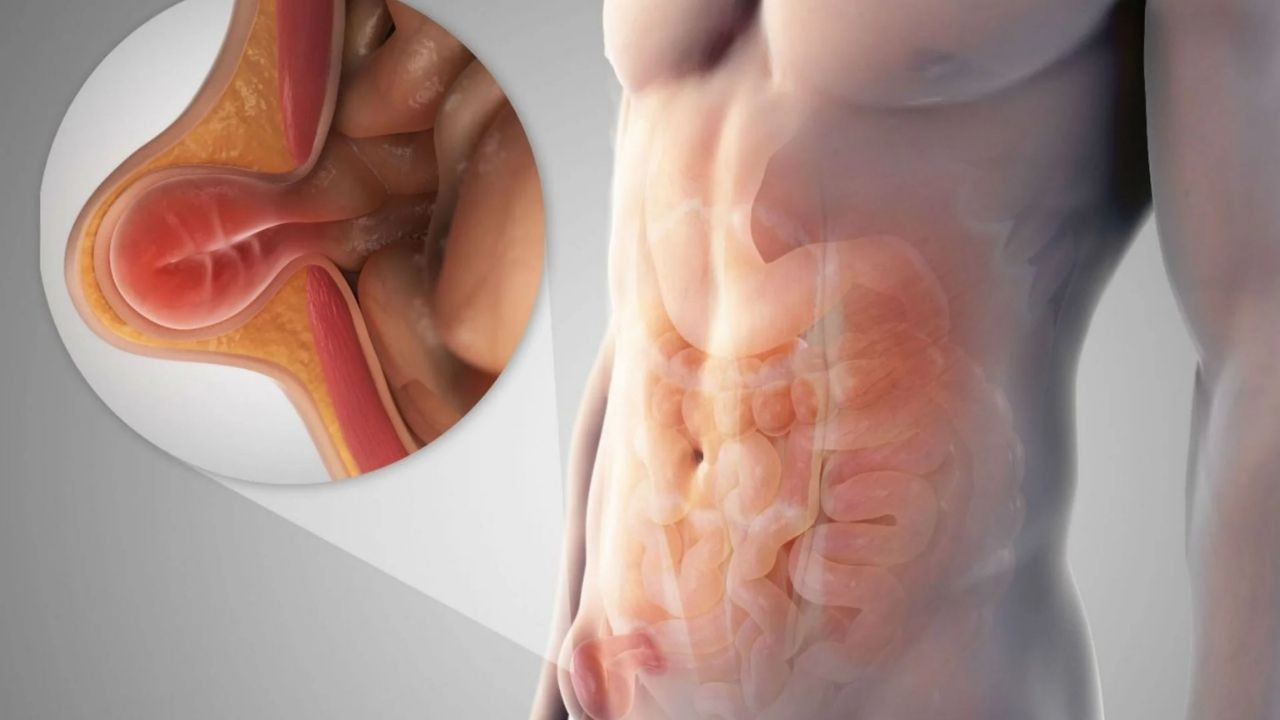 Kasık fıtığı ameliyatı ne kadar sürer?