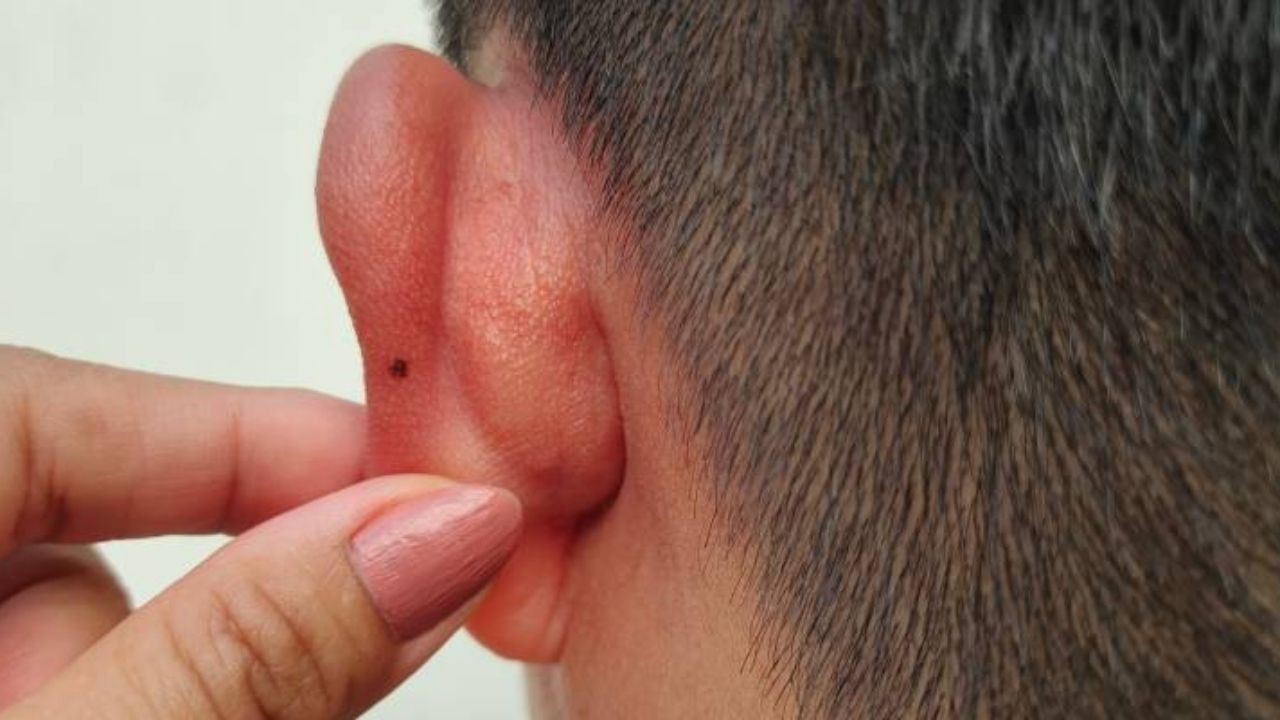 Kulak arkası lenf bezleri şişmesi neden olur?