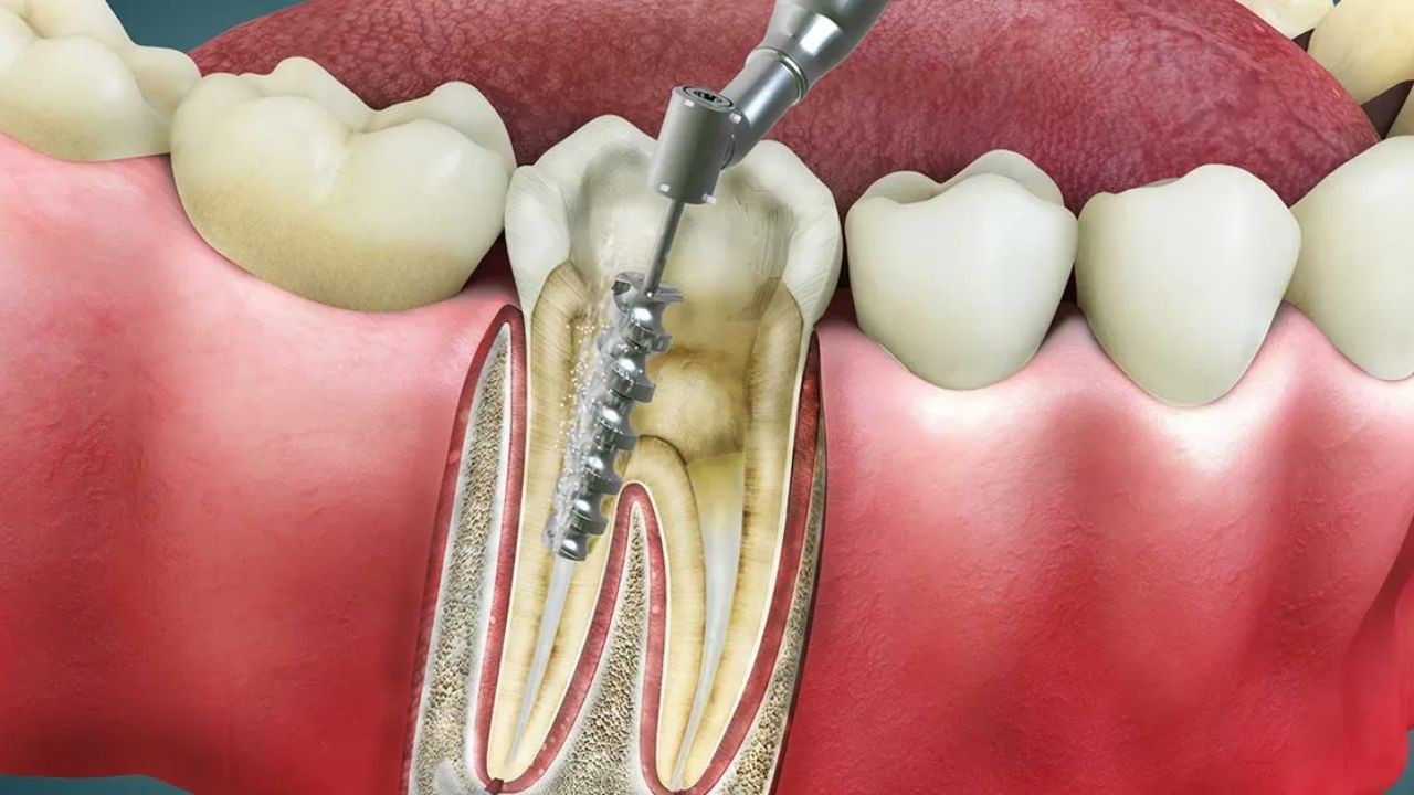Kanal tedaviden sonra diş neden ağrır?