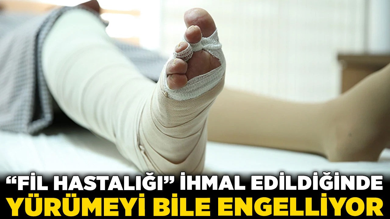 Ciddi tehlike kapıda: "Fil hastalığı” ihmal edildiğinde yürümeyi bile engelliyor!