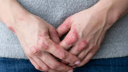 Bağ dokusu hastalığı nedir?