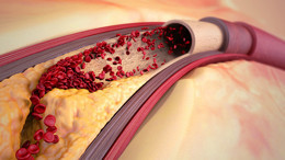 Aterosklerotik kalp hastalığı nedir? Aterosklerotik kalp hastalığının belirtileri neler?