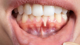 Damak morarması neden olur?