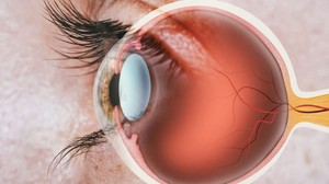 Retina dekolmanı nedir?