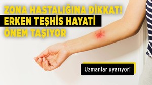 Uzmanlar uyarıyor: Zona hastalığına dikkat! Erken teşhis hayati önem taşıyor!