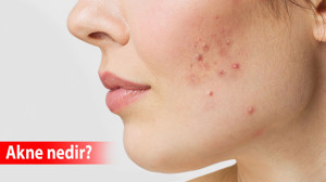 Akne nedir, neden çıkar? Akne nasıl yok edilir? Akne ve sivilce farkı nedir?