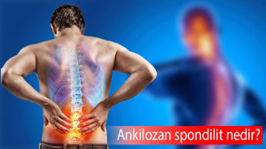 Ankilozan spondilit nedir, ilk belirtileri nelerdir, tehlikeli mi?