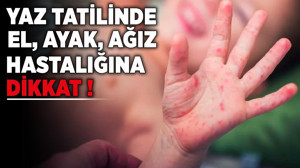 Uzmanlar uyarıyor: Yaz tatilinde el, ayak, ağız hastalığına dikkat!