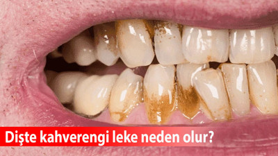Evde kahverengi diş lekesi nasıl temizlenir? Kahverengi lekeler neden oluşur, nasıl çıkar diş?