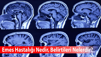 Emes Hastalığı Nedir, Belirtileri Nelerdir?