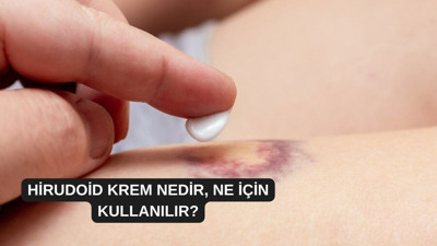 Hirudoid krem nedir, ne için kullanılır?