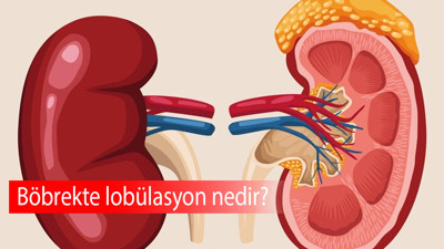 Böbrekte lobülasyon nedir?