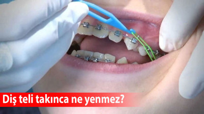 Diş teli takınca ne yenmez?