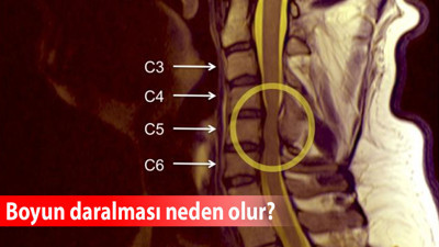 Boyun daralması neden olur?